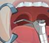 Логические Хирургия: гланды – Tonsil Surgery
